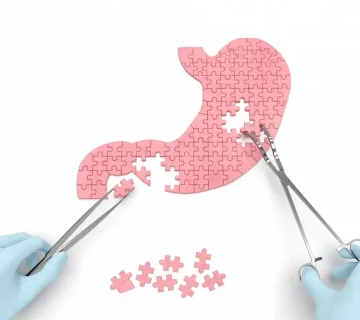 تفاوت بوتاکس معده و اسلیو