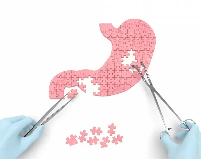 تفاوت بوتاکس معده و اسلیو