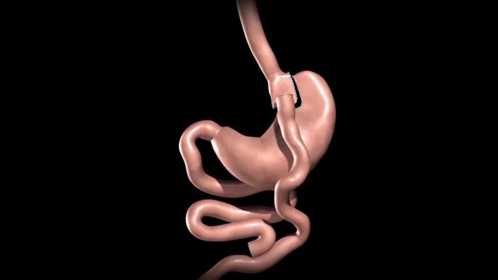 بای پس معده