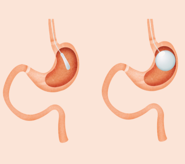 تفاوت بالون معده و بوتاکس معده