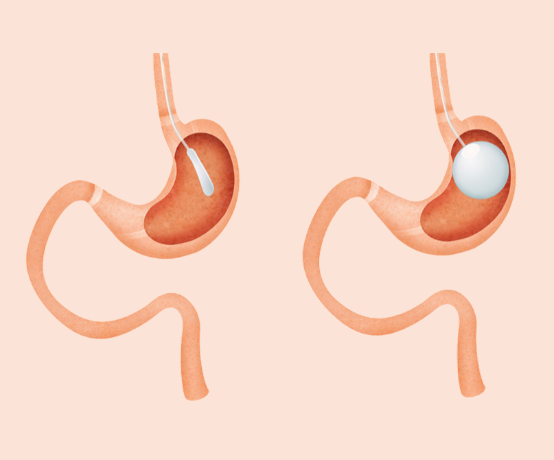 تفاوت بالون معده و بوتاکس معده