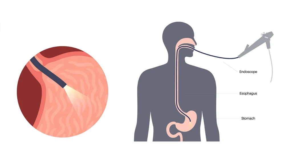 ماندگاری بوتاکس معده .