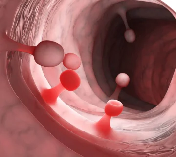 تشخیص پولیپ معده