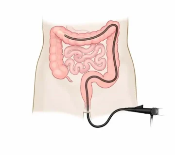 مراقبت های بعد از کولونوسکوپی