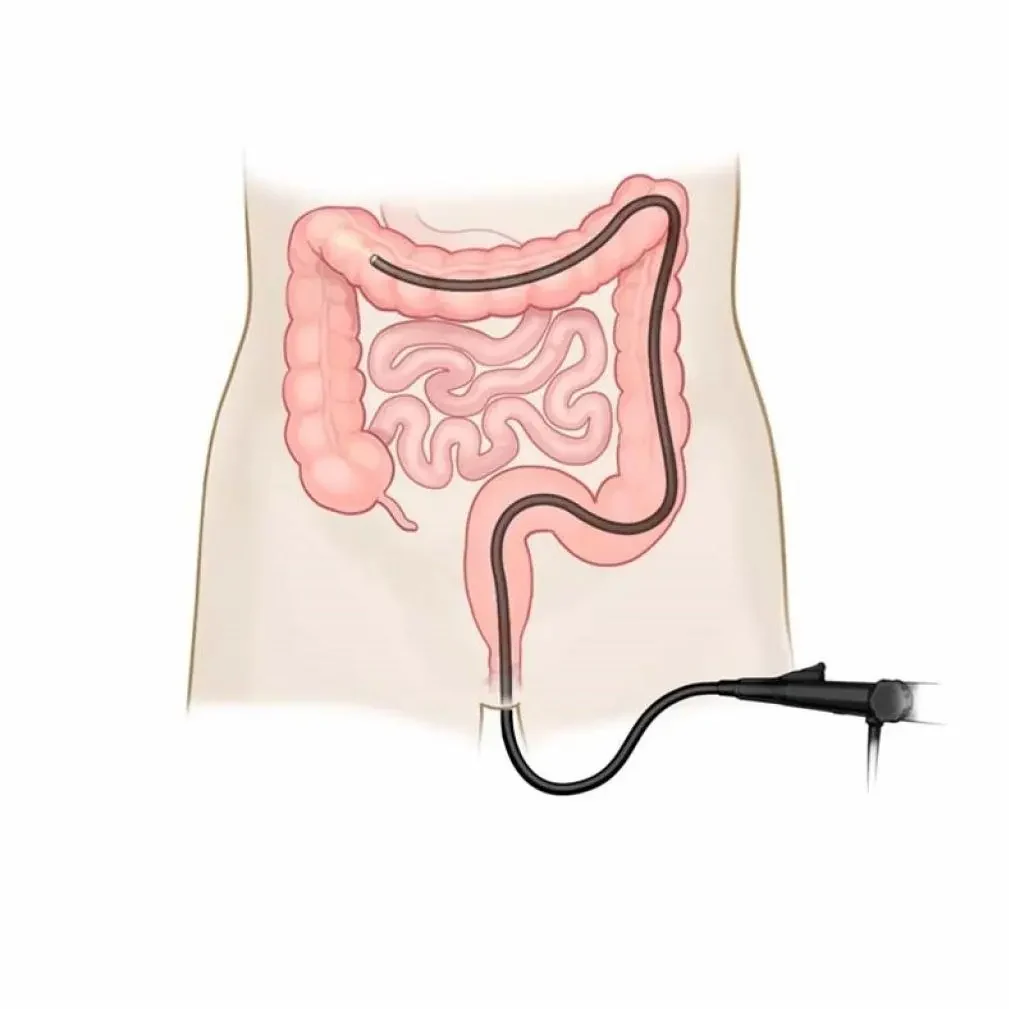 مراقبت های بعد از کولونوسکوپی