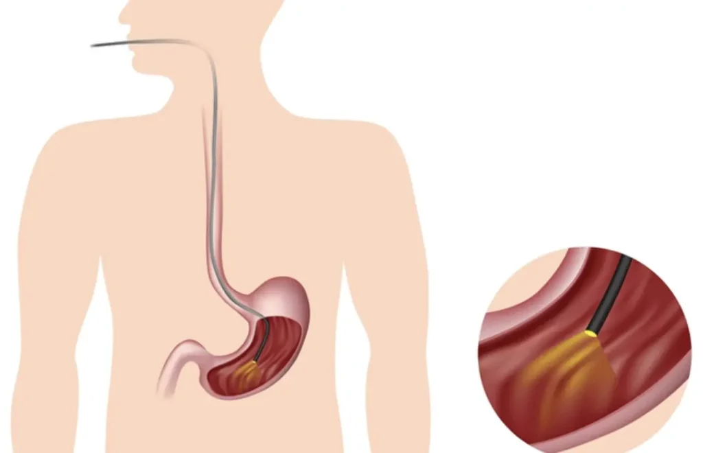 آندوسکوپی معده چه عوارضی دارد