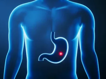 درمان پولیپ معده